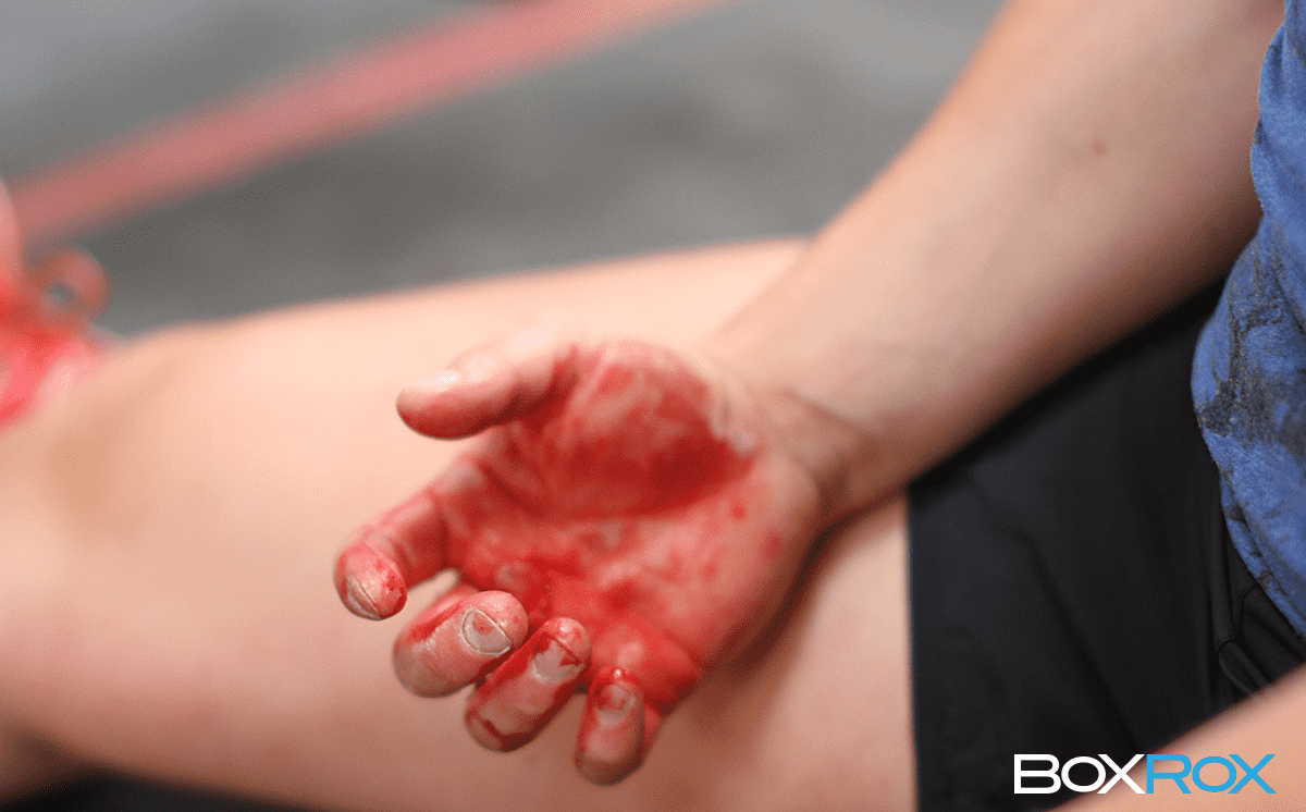 How To Prevent Painful Calluses! BLISTERS NO BLISTERS Bar in