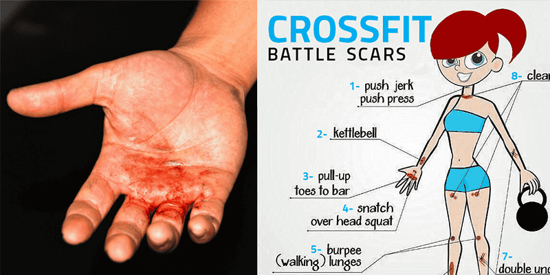 Crossfit-injuries