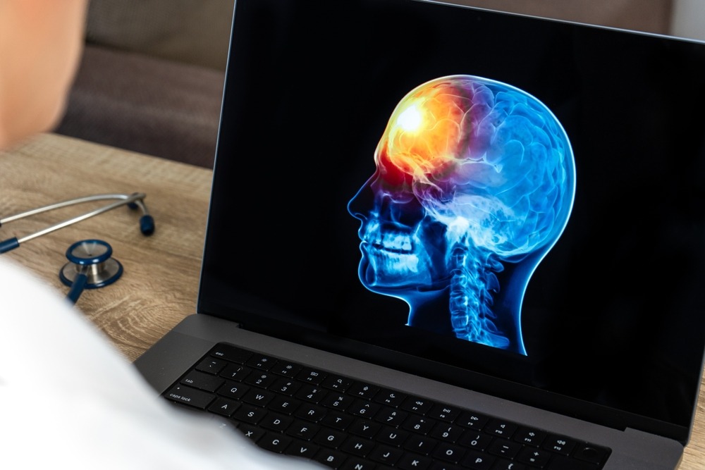 How Compensation Works in Traumatic Brain Injury Cases